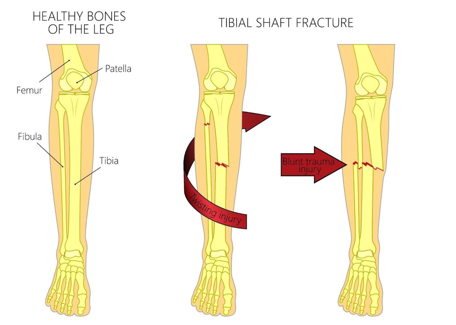 Tibia Fracture Singapore: Symptoms, Causes & Treatment