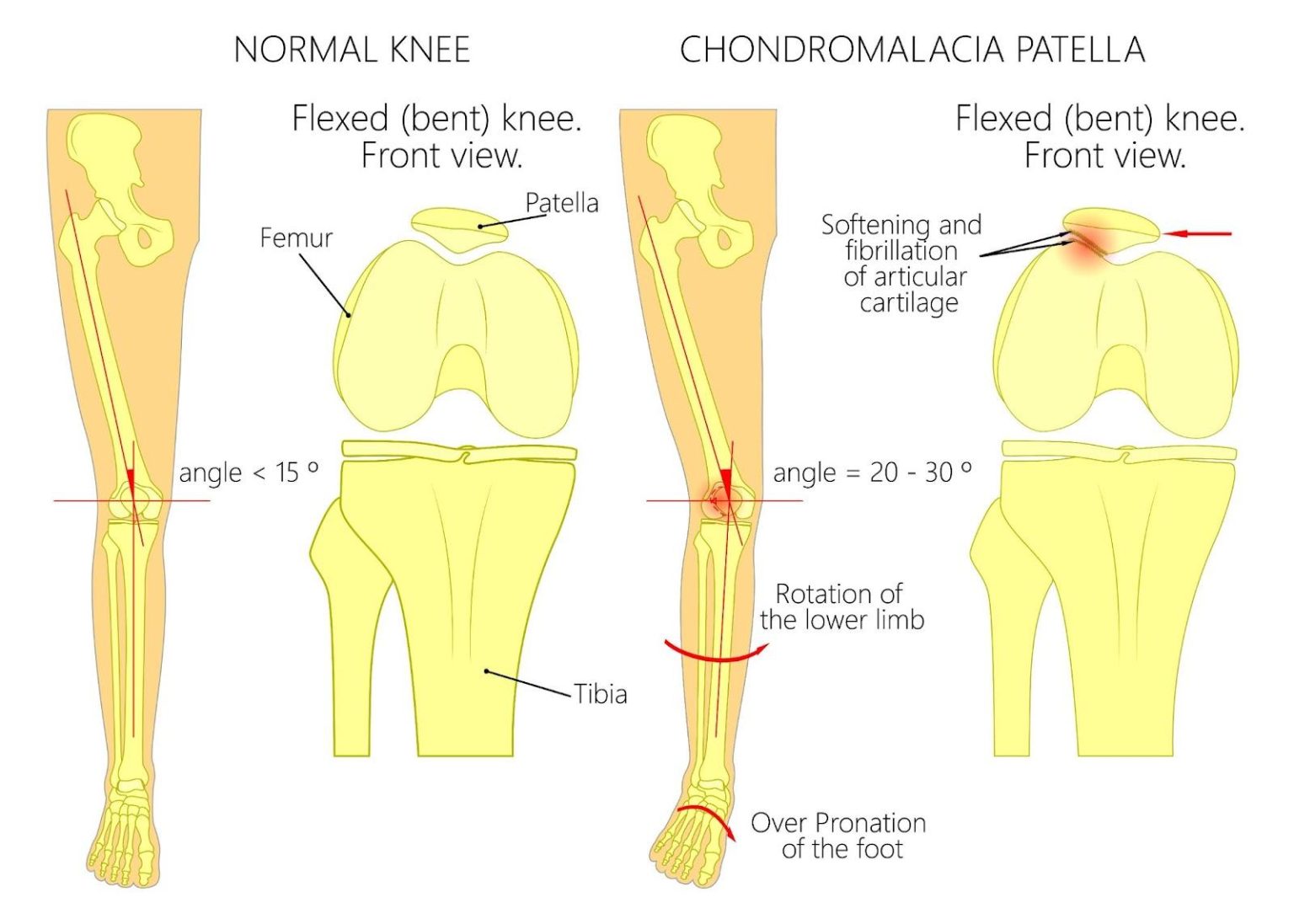 Chondromalacia Patellae Singapore Symptoms Causes Treatment chondromalacia-patellae-singapore-symptoms-causes-treatment