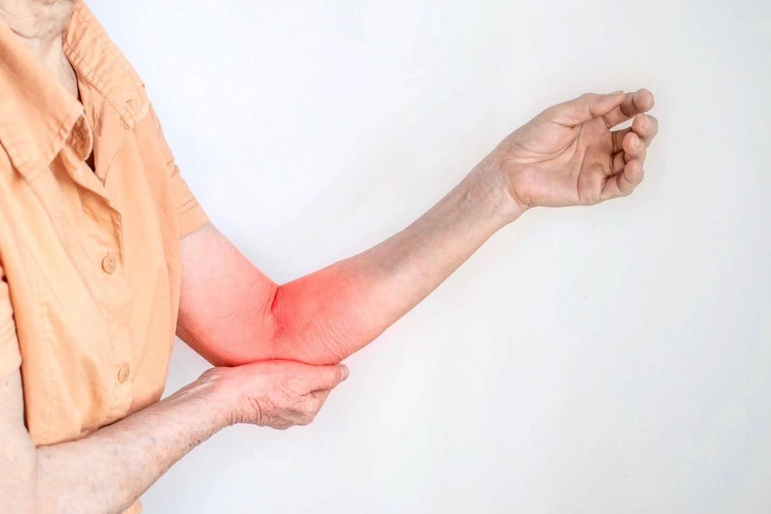what is cubital tunnel syndrome.