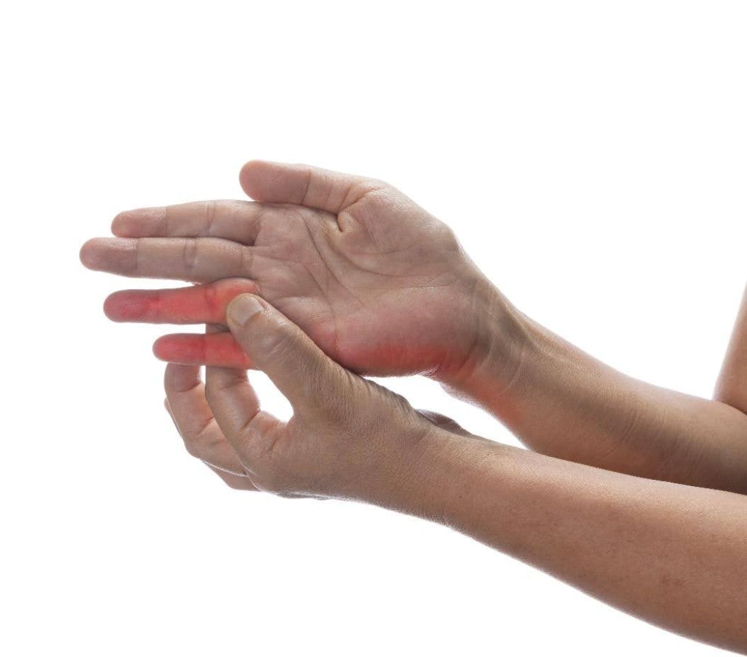 cubital tunnel syndrome symptoms.