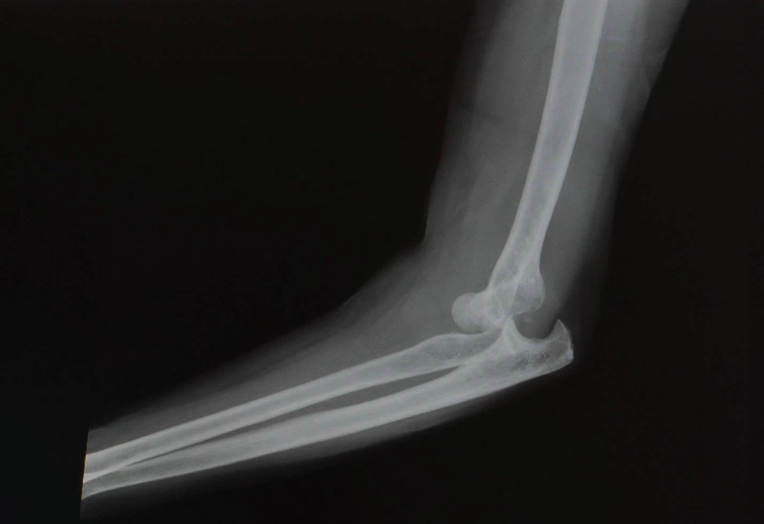 how to diagnose elbow dislocation in Singapore.
