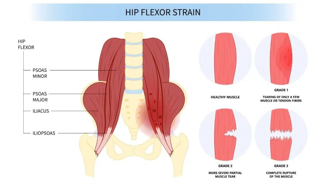 Hip Flexor Anatomy Diagram Mike Boyle Understanding And Training Hip Hip Flexor Anatomy Diagram Mike Boyle Understanding And Training Hip