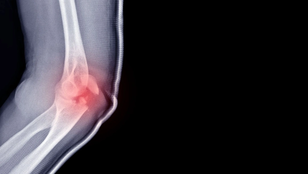 Elbow Fracture Singapore
