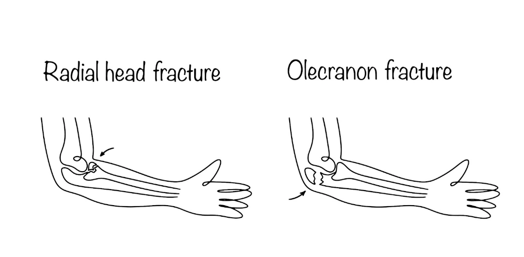 Radial Head Fracture Vs. Olecranon Fracture Singapore