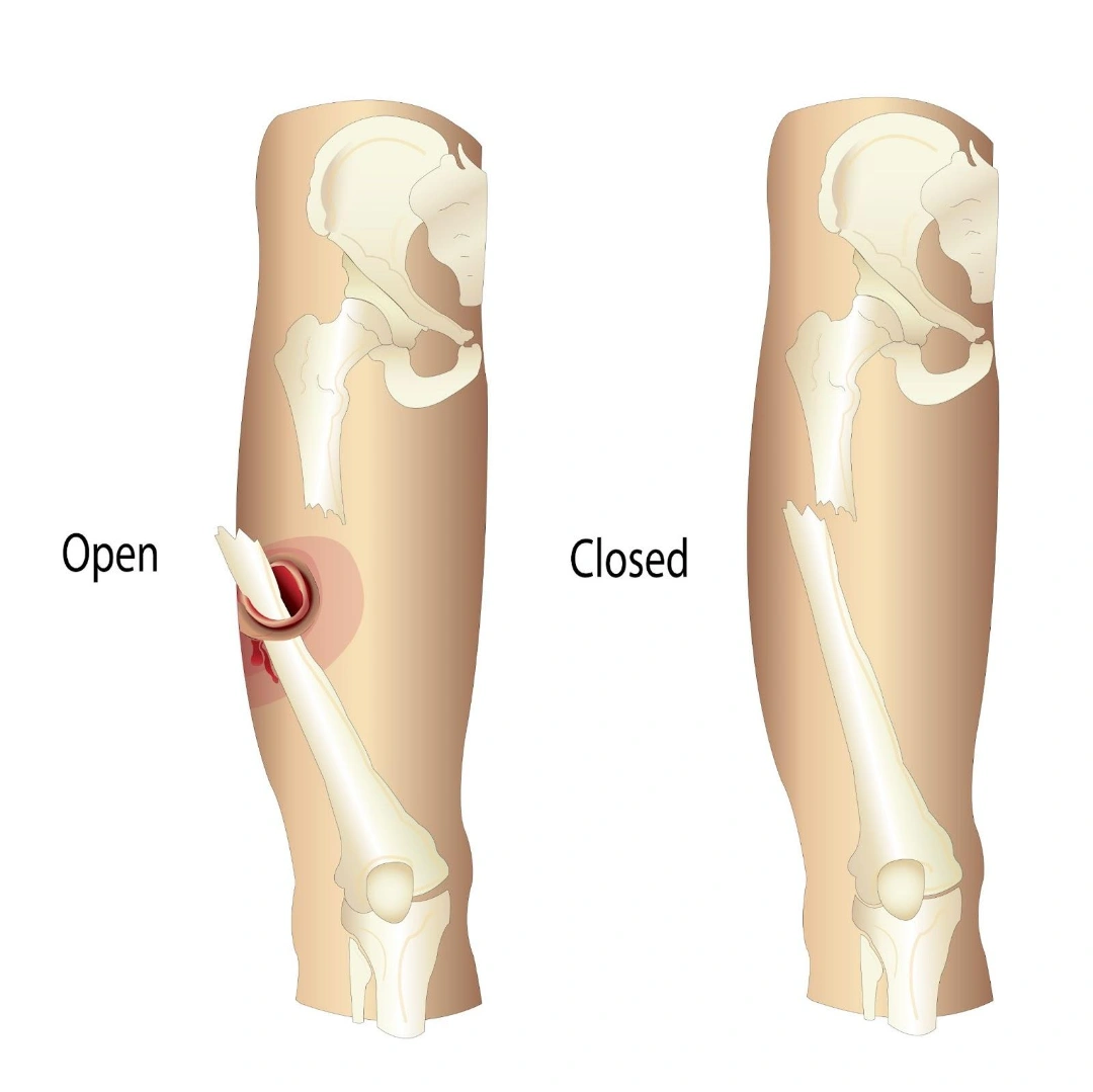 Femur Fractures Singapore
