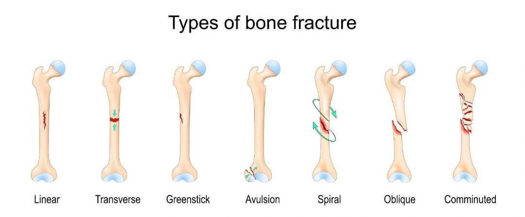 Types of Femur Fractures Singapore