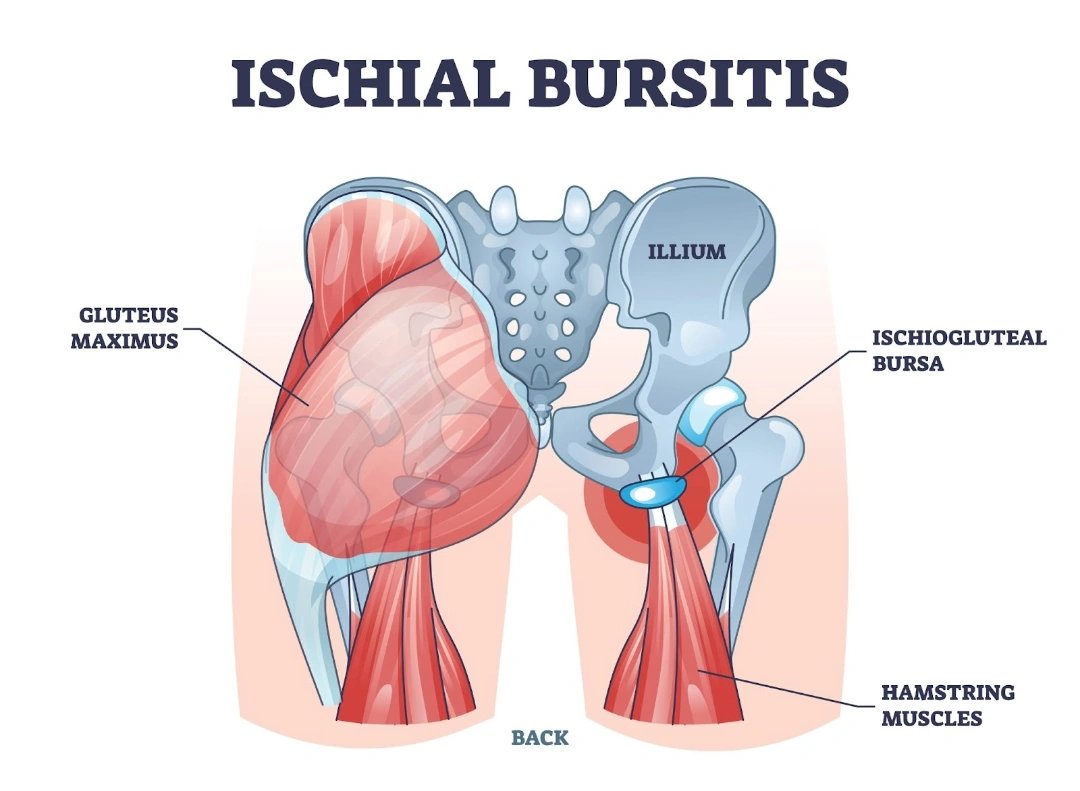 Causes of Ischial Bursitis Singapore