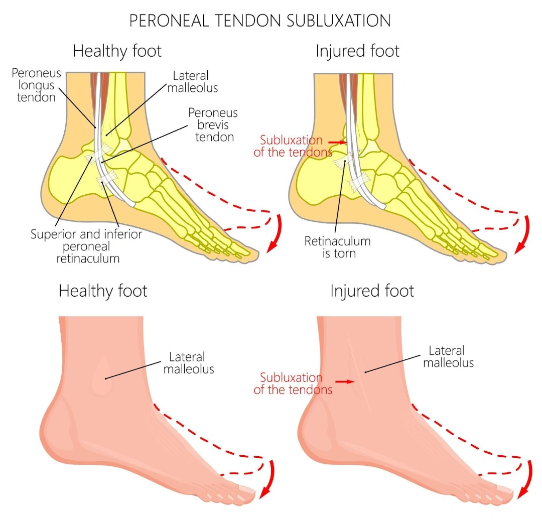 Peroneal Subluxation Singapore