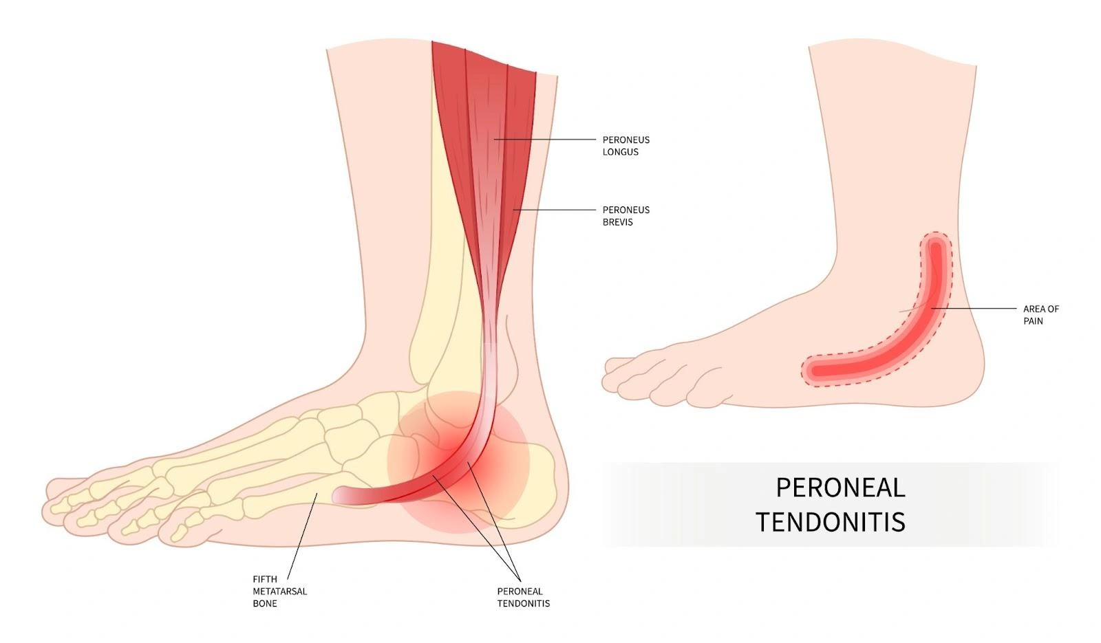 Peroneal Tendinopathy Singapore