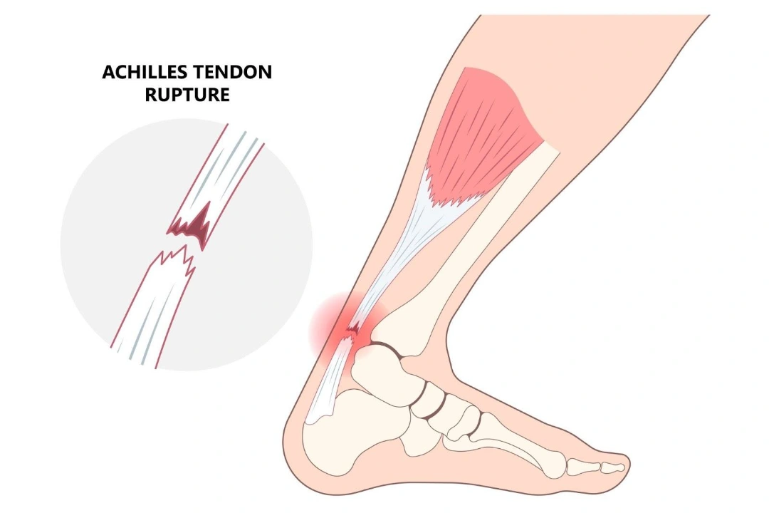 Cause of Achilles Tear Singapore