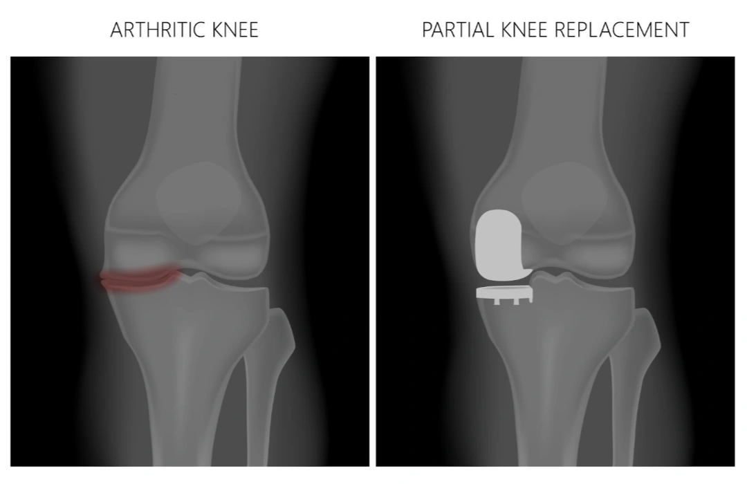 partial knee replacement singapore