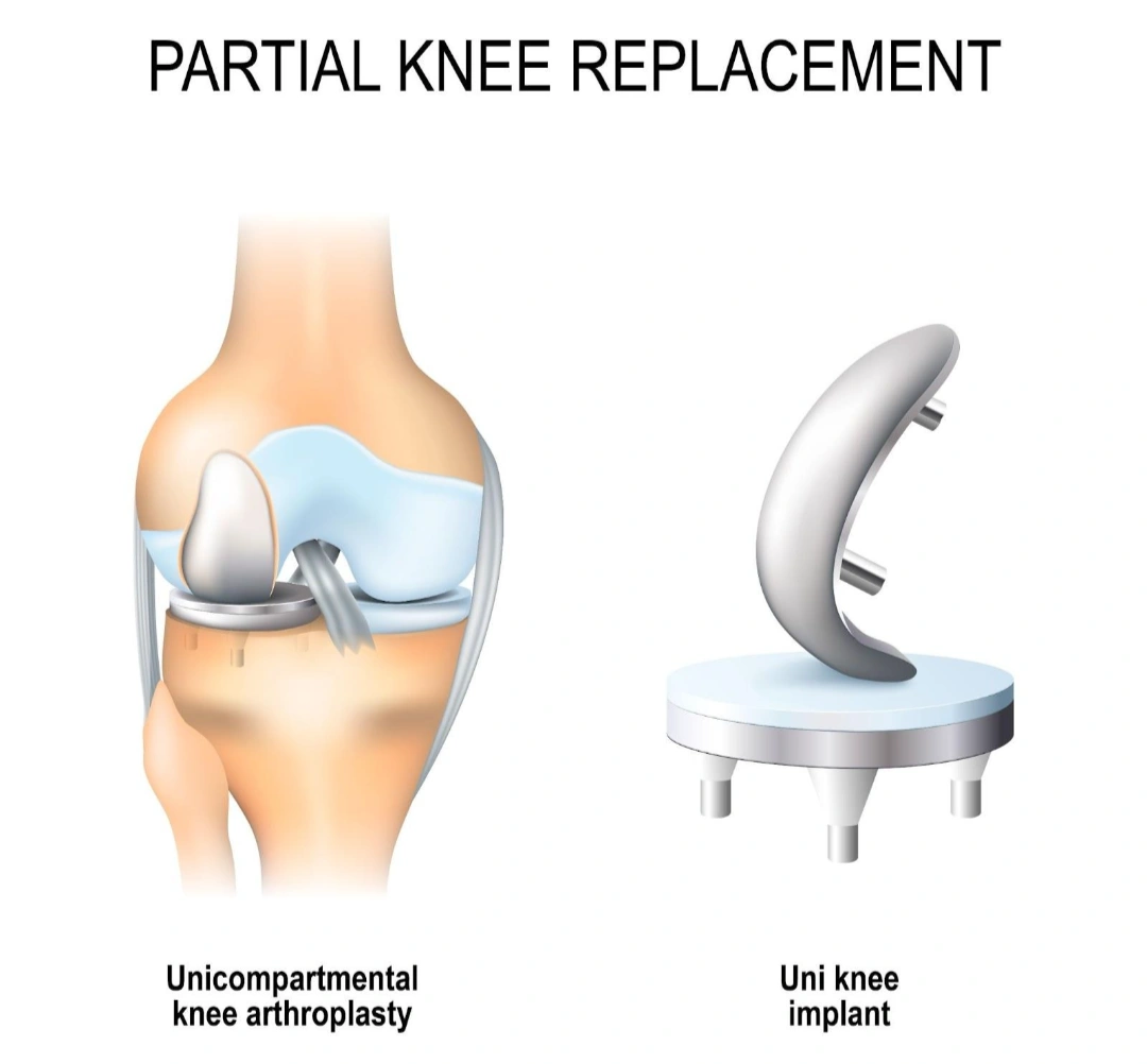 Partial Knee Replacement Singapore