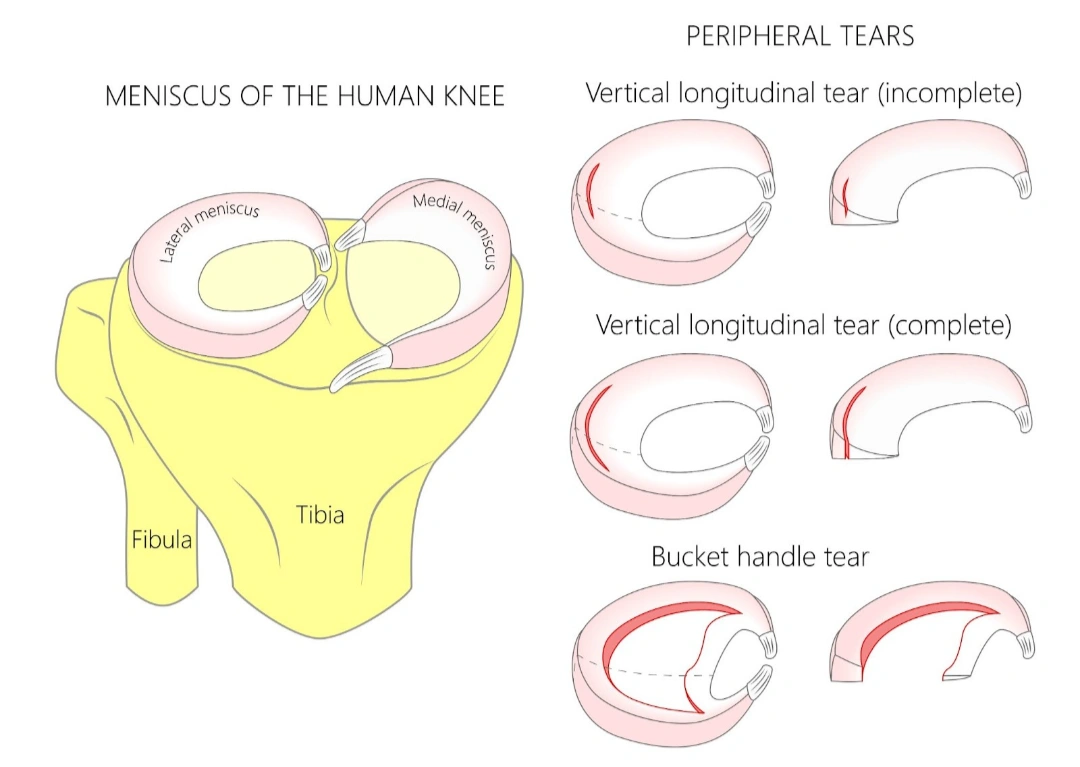 Partial Knee Replacement Vs. Total Knee Replacement Singapore